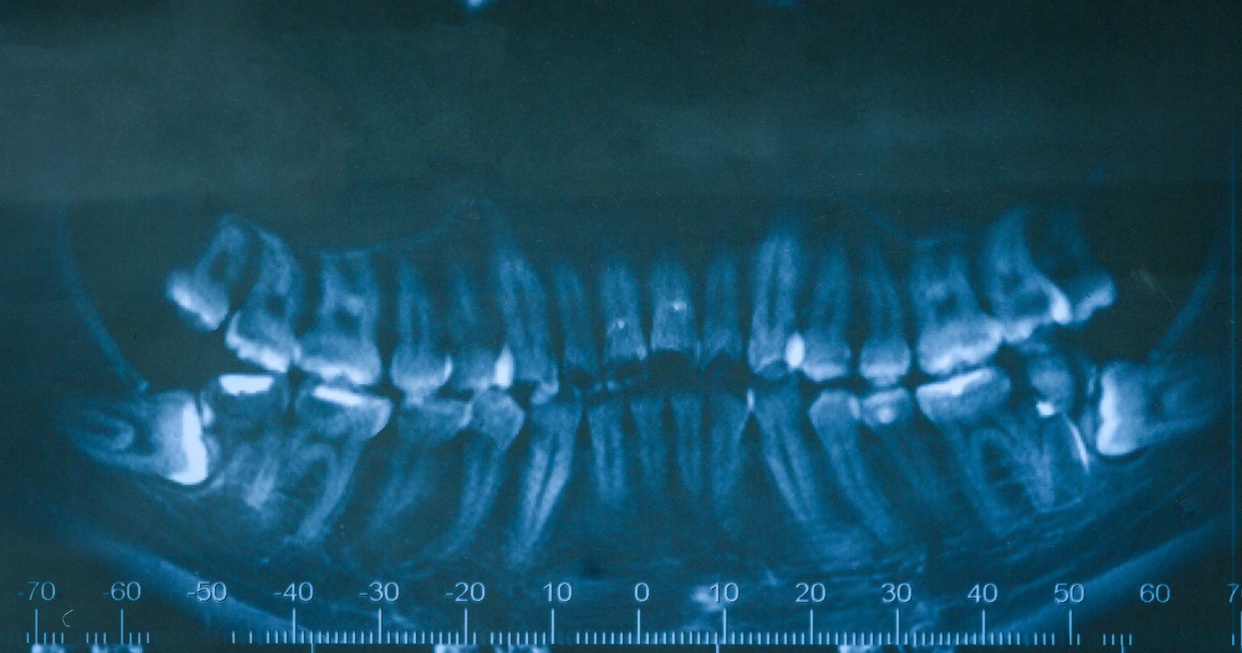 Radiografía intraoral de piezas dentales