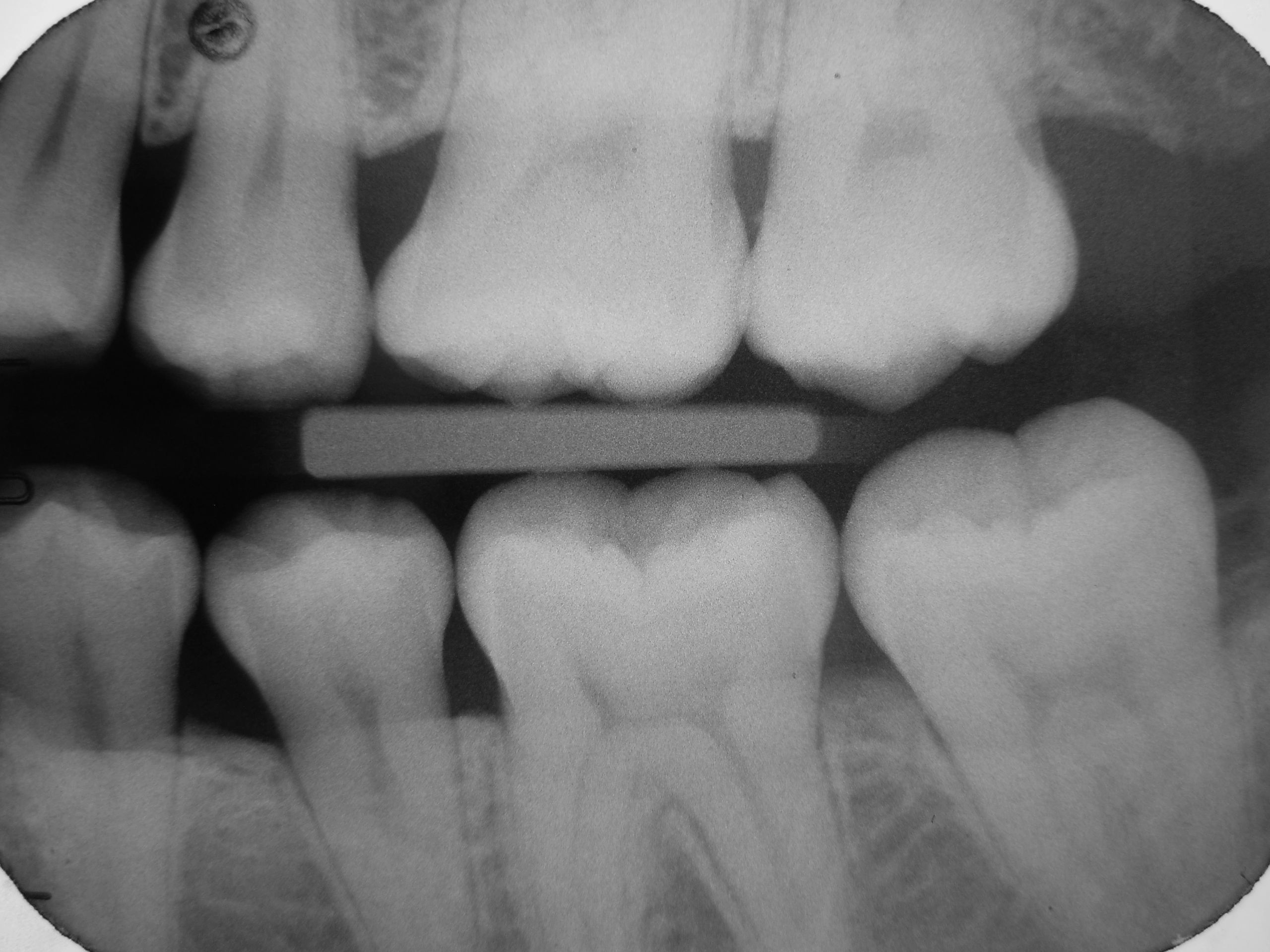 RadiografÃa intraoral dental